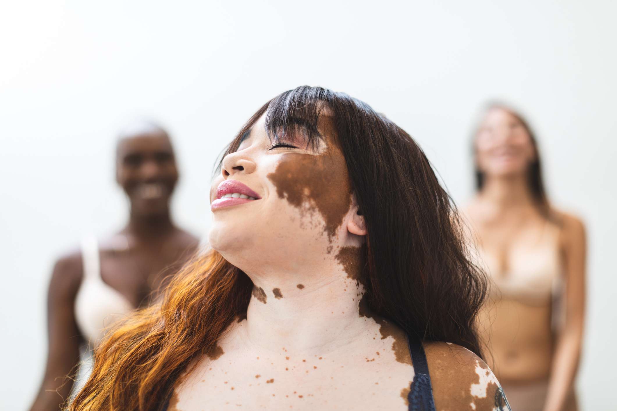 Photographer with vitiligo takes pictures of other women with the same condition (35 pics) | demilked